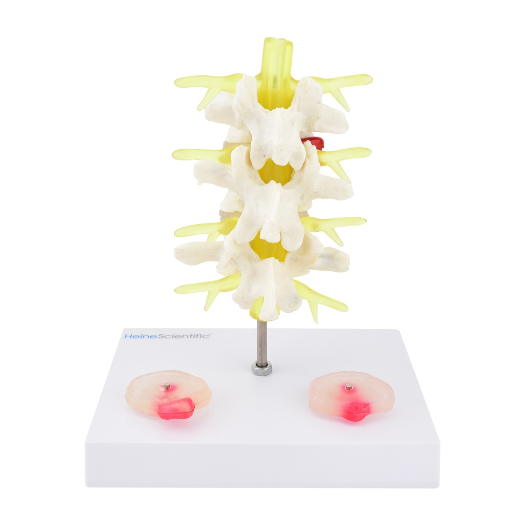 3-14790-01-heinescientific-bandscheibenvorfall-modell.jpg