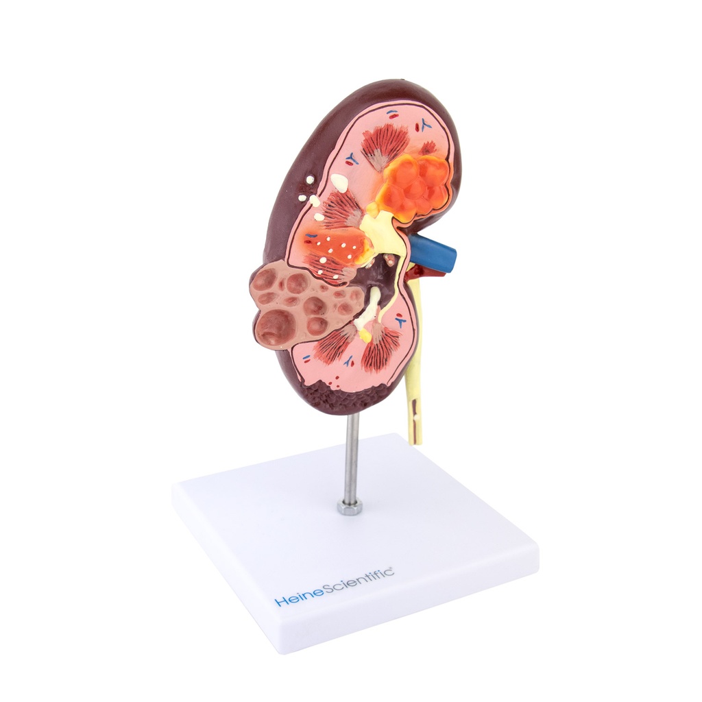 4-21513-01-heinescientific-modell-niere-mit-zysten.jpg