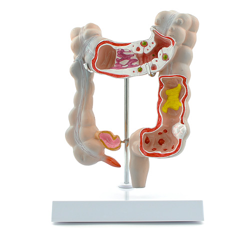 HEINESCIENTIFIC Human colon as section model with multiple disease patterns