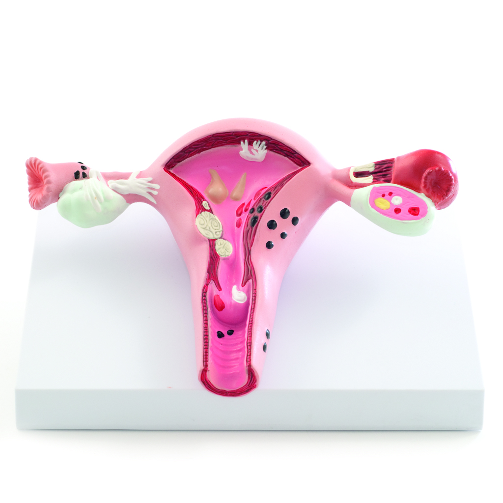 HEINESCIENTIFIC Anatomisches Modell der Gebärmutter-Erkrankungen