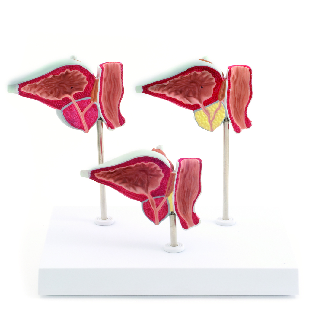 HEINESCIENTIFIC Three-part model of prostate diseases