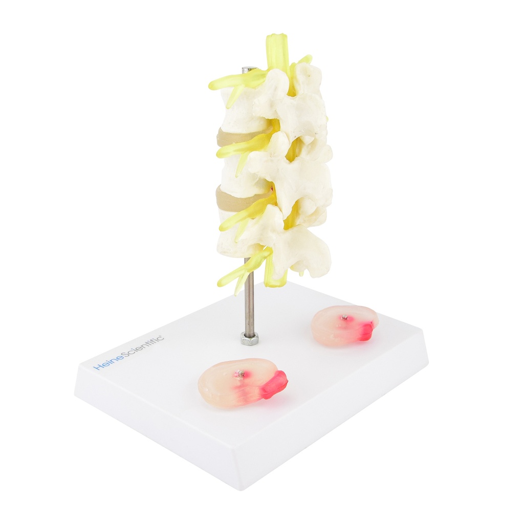 HEINESCIENTIFIC Bandscheibenvorfall-Modell