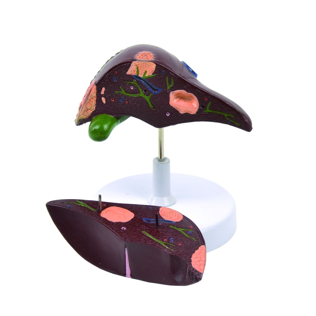 HEINESCIENTIFIC Model of the liver with various diseases