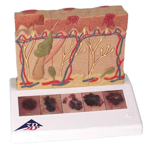 3B Scientific Skin cancer model 8-times size