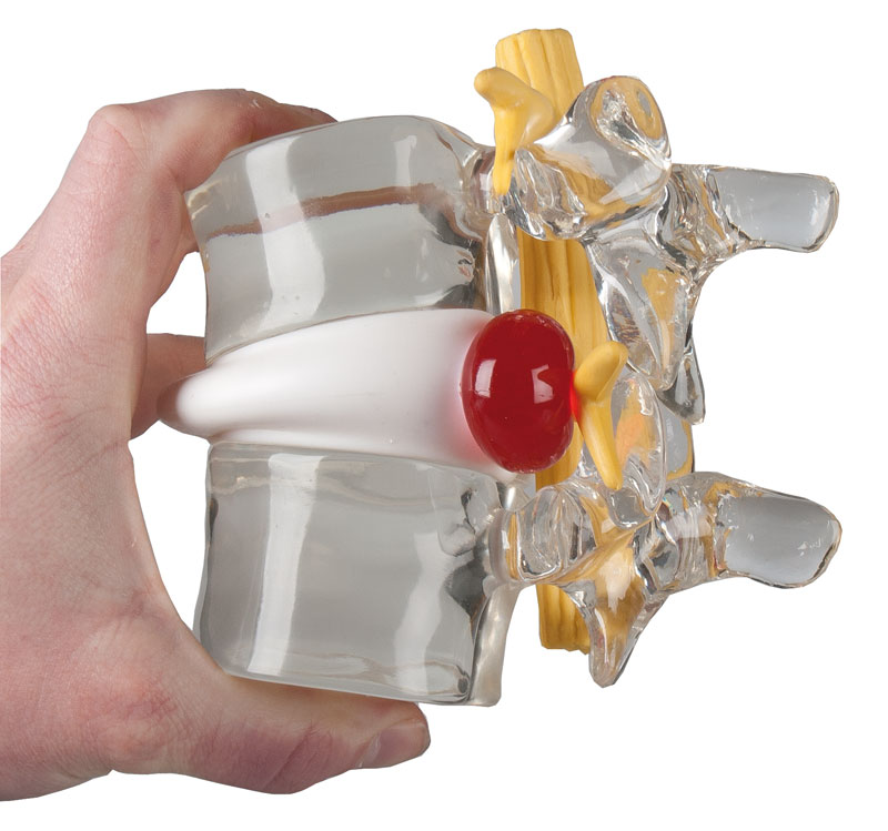 ERLERZIMMER Disc Prolapse Simulator