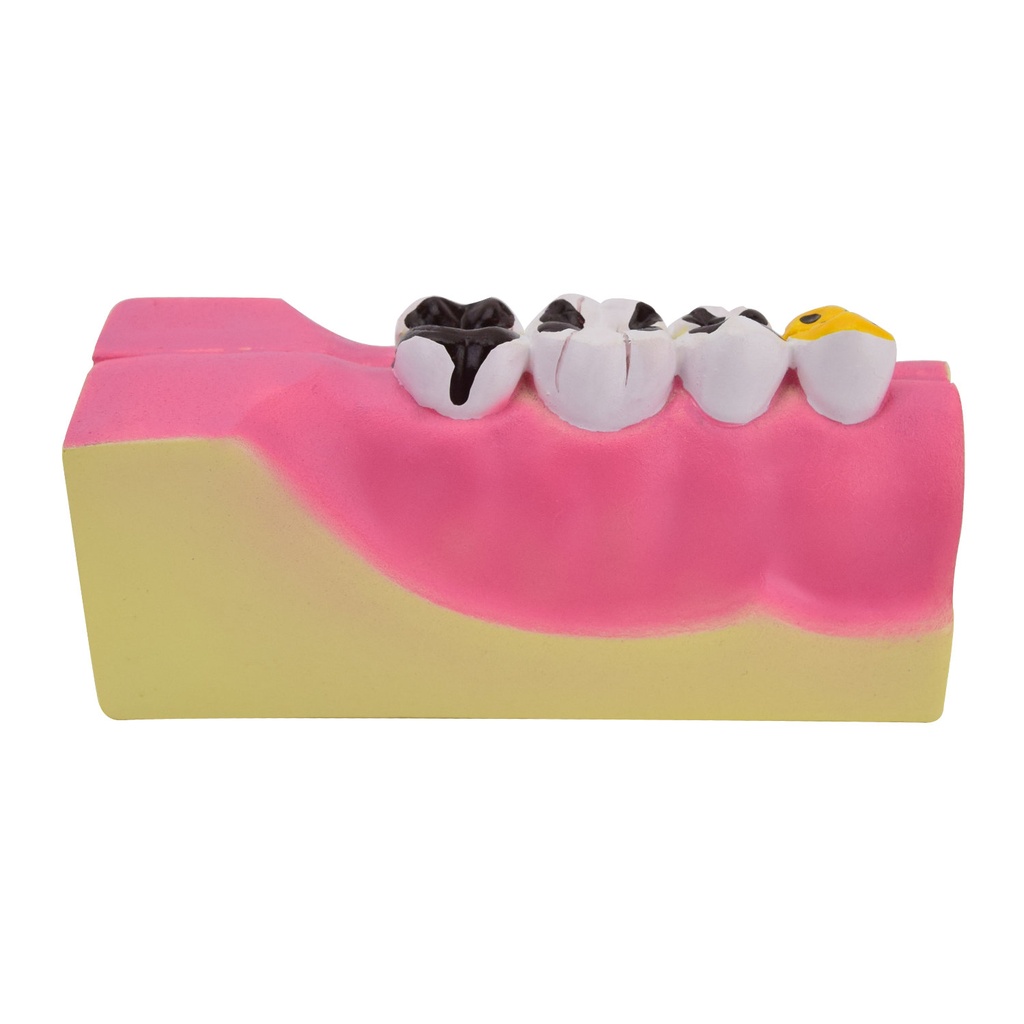 HEINESCIENTIFIC Partial model of the lower jaw with disease