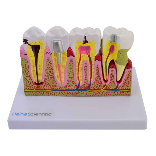 [21497-01] HEINESCIENTIFIC Model with diseased molar teeth