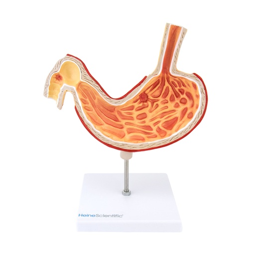 [21506-01] HEINESCIENTIFIC Model of a stomach with ulcers