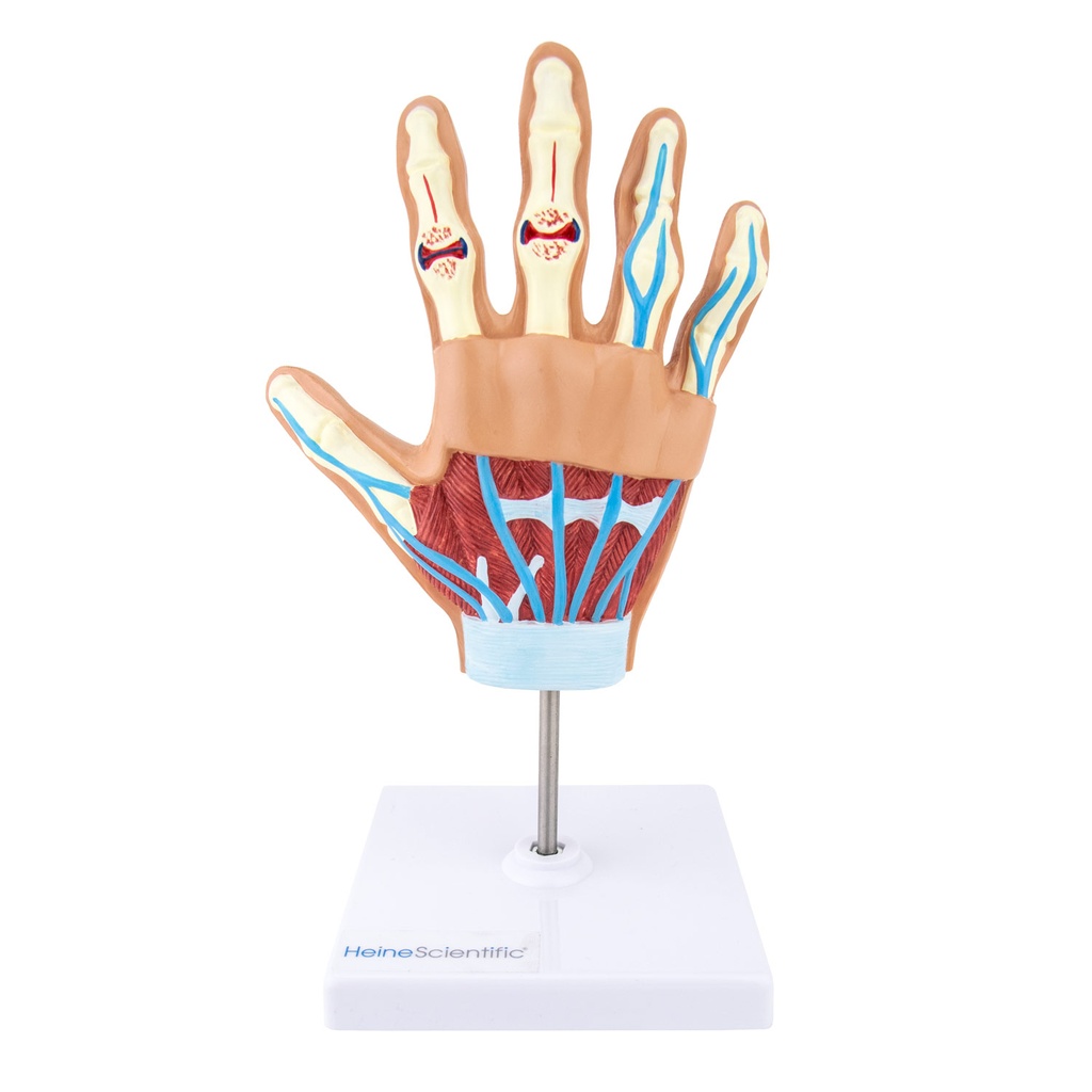 HEINESCIENTIFIC Hand model with rheumatoid arthritis