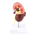 HEINESCIENTIFIC Model of a kidney with cysts