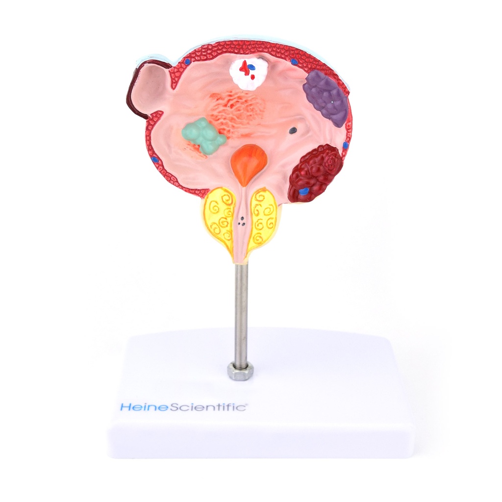 HEINESCIENTIFIC Model of the male bladder and prostate with diseases