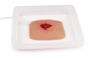 ERLERZIMMER Wujndmoulage wound packing