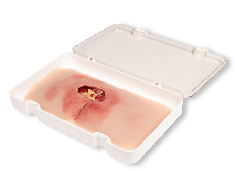 ERLERZIMMER Wound Moulage Sacral Decubitus, cleaned