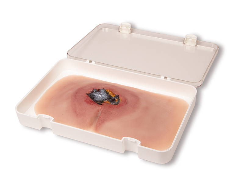 ERLERZIMMER Wound Moulage Sacral Decubitus untreated