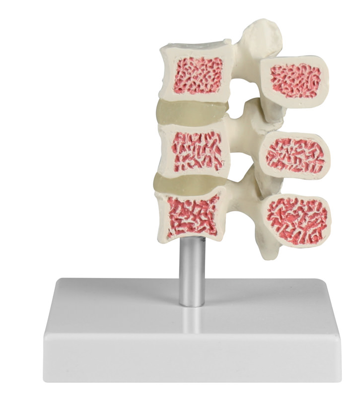 ERLERZIMMER Osteoporosis Vertebra Model, 3 Vertebrae