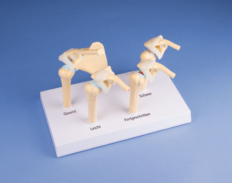 ERLERZIMMER 4-Stadien-Osteoarthritis (OA) Schulter