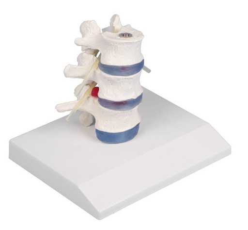 [24550-01] ERLERZIMMER Lumbar Vertebra with Disc Herniation