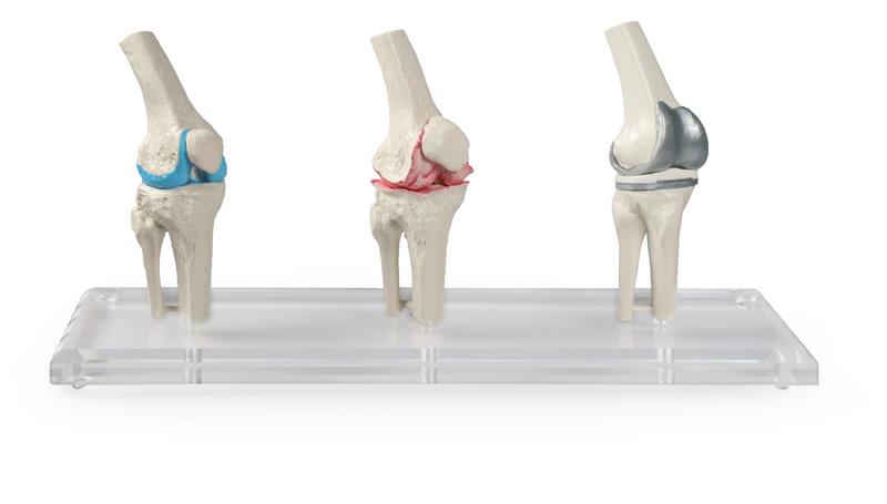 ERLERZIMMER Knie-Implantat-Modell