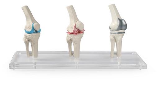 [24560-01] ERLERZIMMER Knee Implant Model