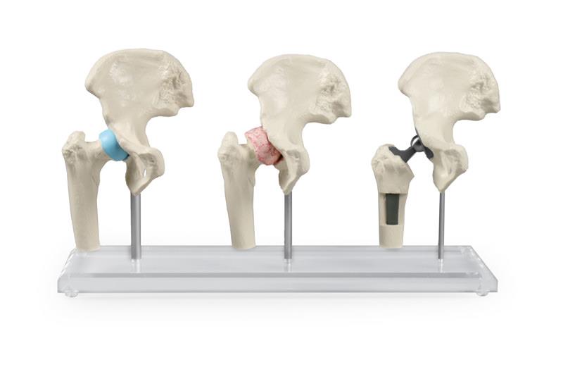 ERLERZIMMER Hüft-Implantat-Modell