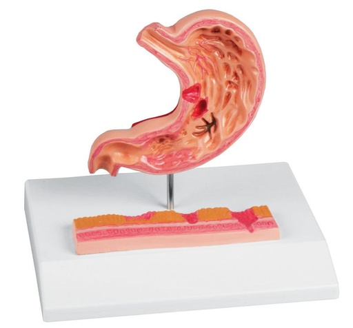 [24582-01] ERLERZIMMER Stomach with Gastric Ulcers