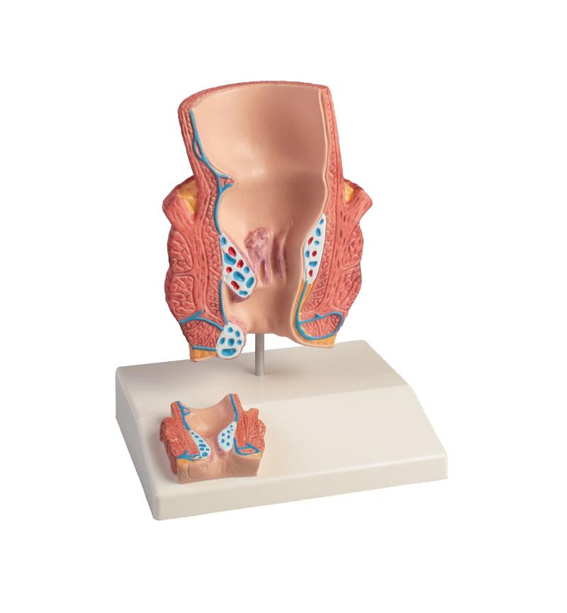 ERLERZIMMER Hämorrhoidenmodell, 2-fache Größe