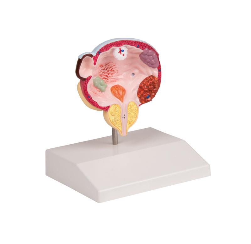 ERLERZIMMER Diseases of Bladder and Prostate