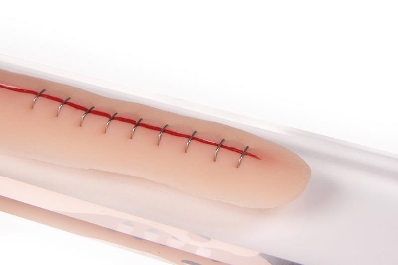 ERLERZIMMER Surgical Wound, stapled, 22cm