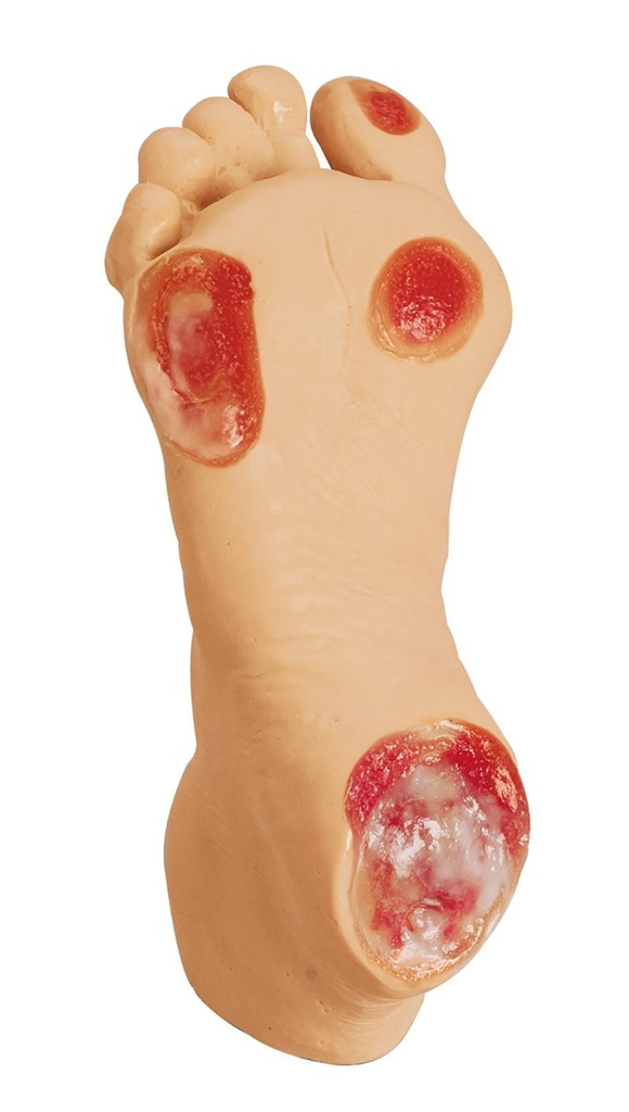 ERLERZIMMER Geriatric Pressure Ulcer Foot