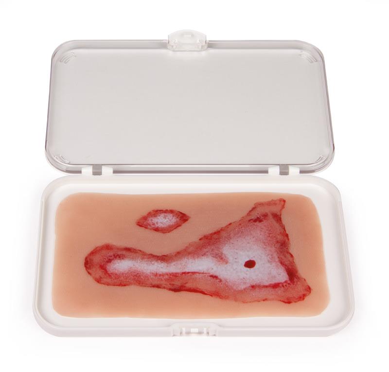 ERLERZIMMER Wundmoulage Verbrühung