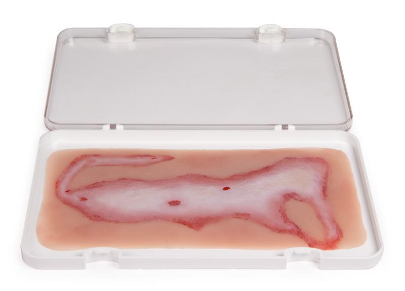 ERLERZIMMER Wundmoulage Verbrühung