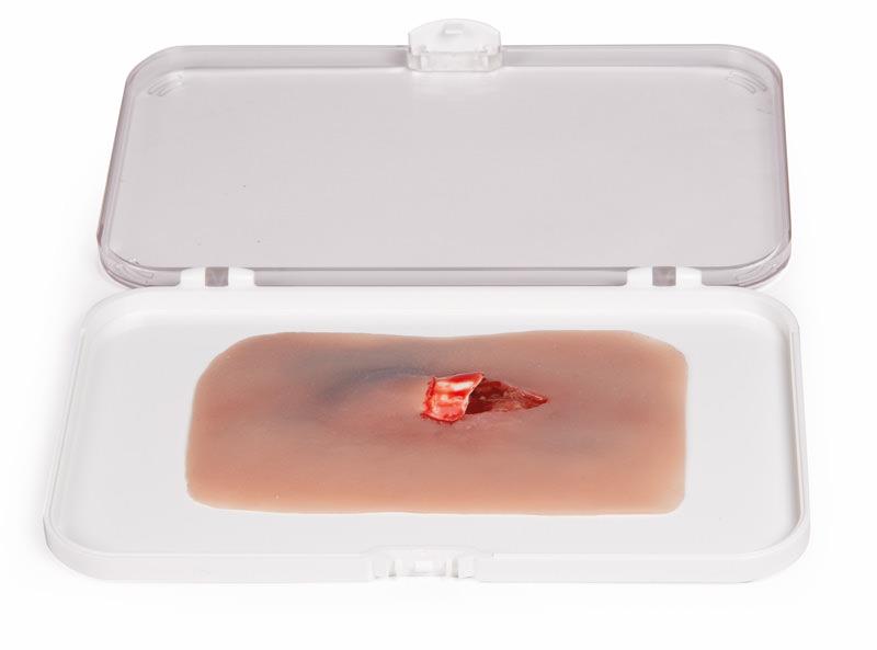 ERLERZIMMER Wound Moulage Open Bone Fracture