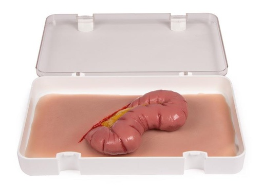 [24688-01] ERLERZIMMER Wundmoulage Dickdarmaustritt
