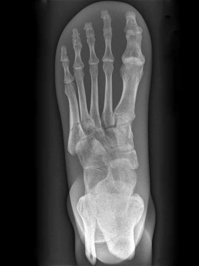 ERLERZIMMER X-Ray Phantom Foot, opaque