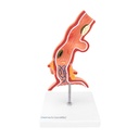 HEINESCIENTIFIC Esophagus model with diseases