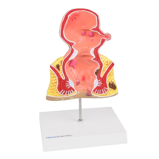 [27071-01] HEINESCIENTIFIC Rectum model with diseases