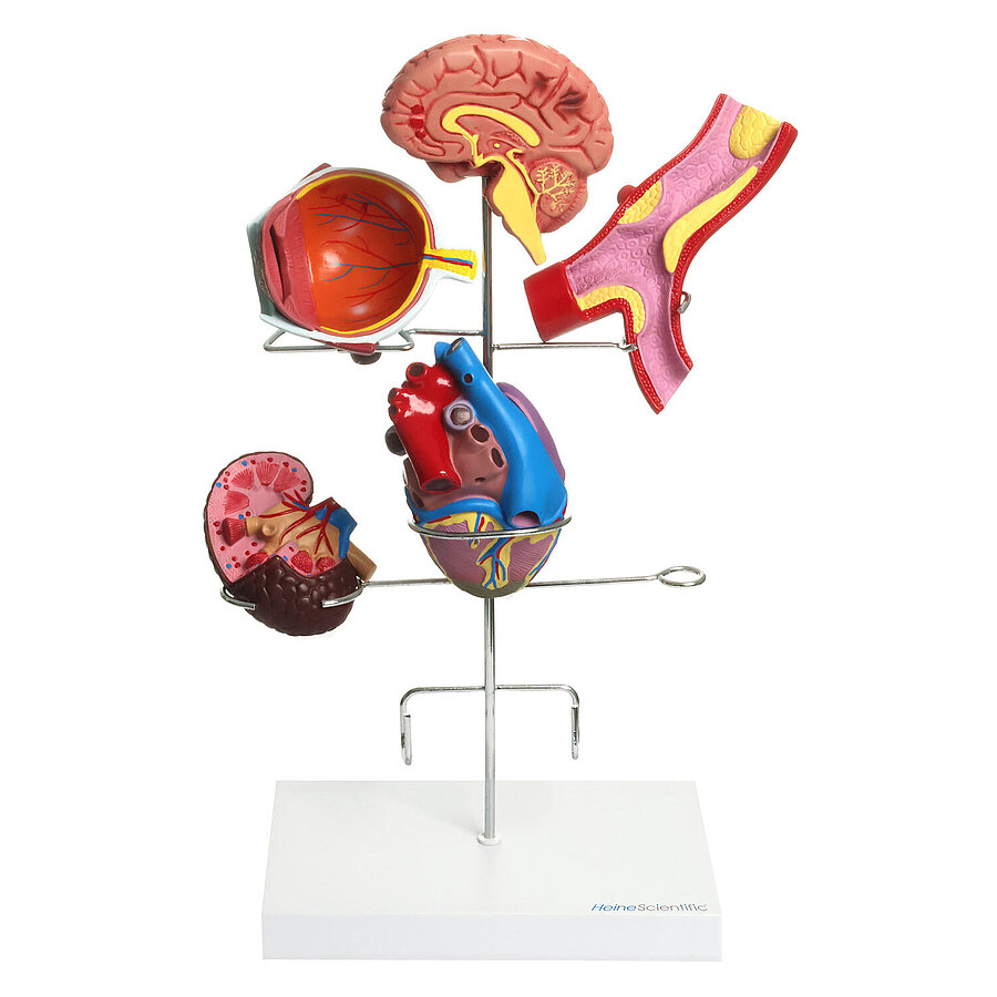HEINESCIENTIFIC Model of hypertension consequences