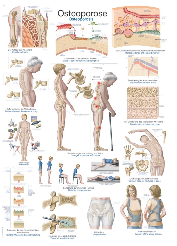 ERLERZIMMER Anatomische Lehrtafel Osteoporose